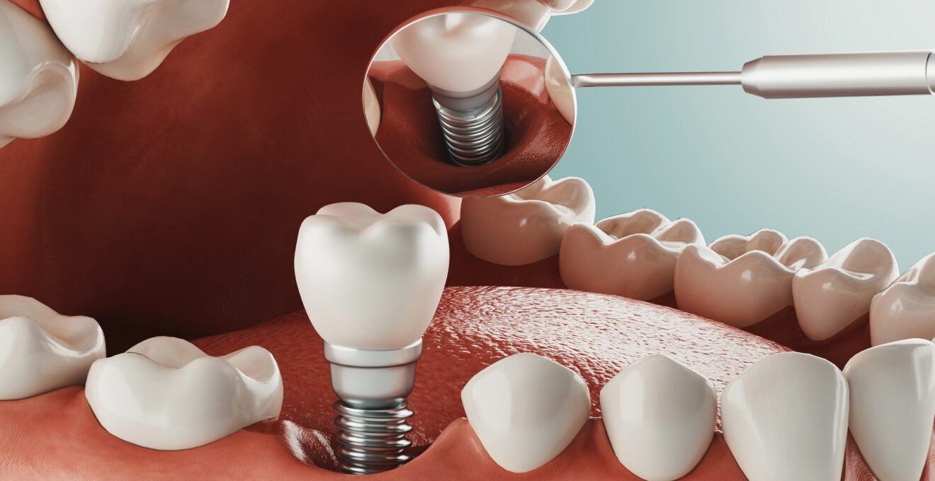Implant dentaire