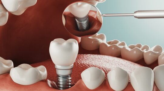 Implant dentaire